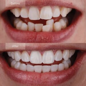 invisalign before and after picture